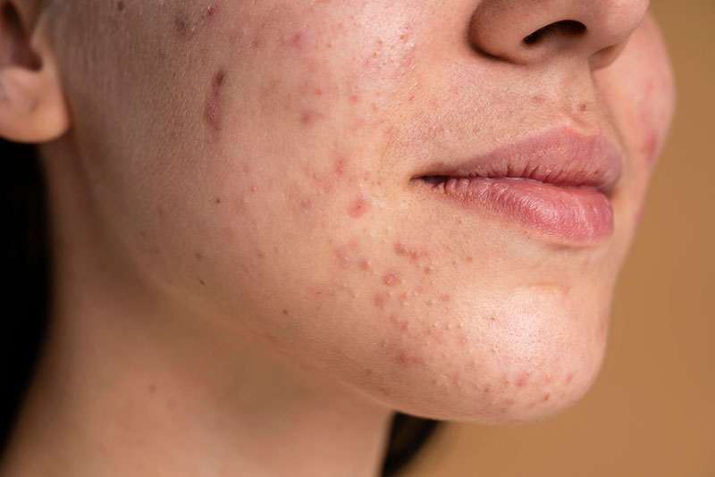 Peau du visage avec de l'acné et des cicatrices, représentant les problèmes de peau courants traités naturellement en naturopathie.